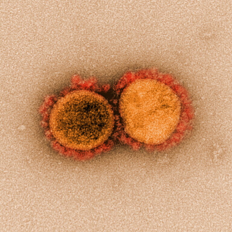 epa08319732 An undated handout image captured and color-enhanced at the National Institute of Allergy and Infectious Diseases (NIAID) Integrated Research Facility (IRF) in Fort Detrick, Maryland, USA and made available by the National Institutes of Health (NIH) shows a transmission electron micrograph of SARS-CoV-2 virus particles, isolated from a patient (issued 24 March 2020). The novel coronavirus SARS-COV-2, which causes the Covid-19 disease, has been recognized as a pandemic by the World Health Organization (WHO) on 11 March 2020. EPA/NIAID/NATIONAL INSTITUTES OF HEALTH HANDOUT HANDOUT EDITORIAL USE ONLY/NO SALES